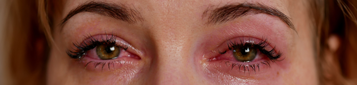 Conjunctivitis